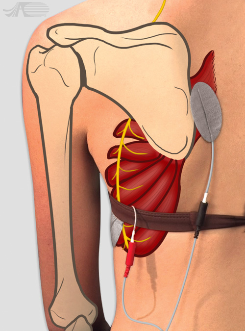 Trapezius Muscles Electrode Placement for Compex Muscle Stimulators 